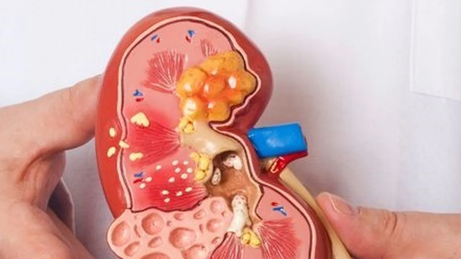 ¿Qué especialista trata el síndrome nefrótico?